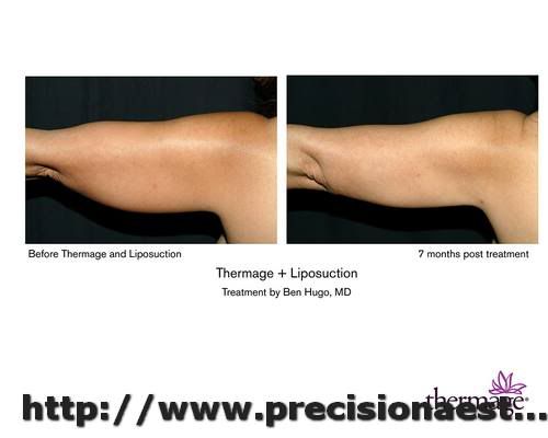 thermage before after. thermage0021.jpg thermage before after